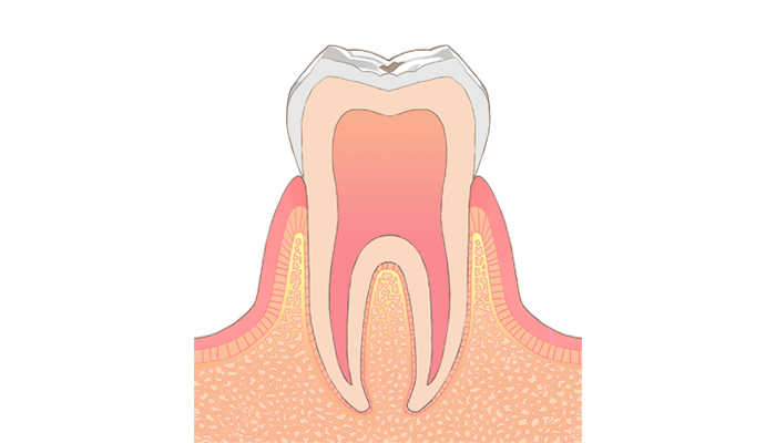C0：ごく初期の虫歯