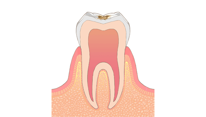 C1：エナメル質内の虫歯