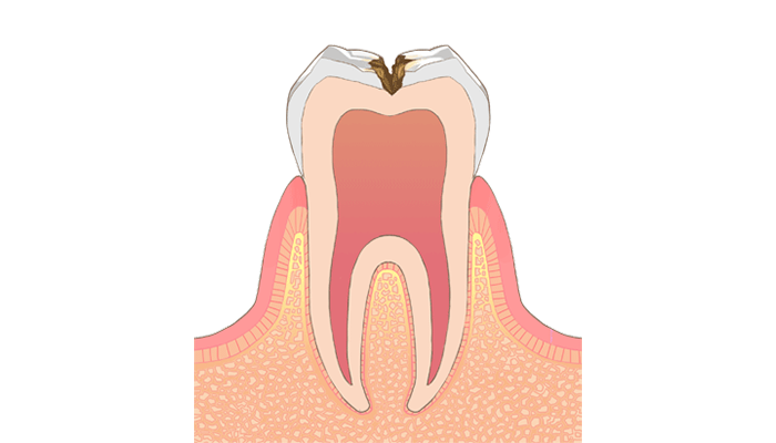 C2：象牙質に達した虫歯