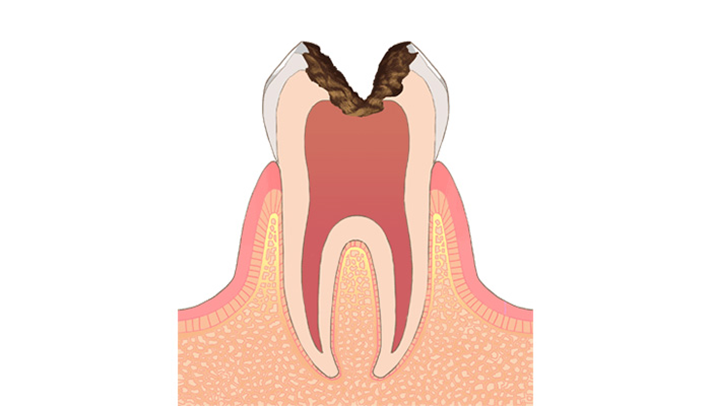 C3：歯髄（神経)に達した虫歯