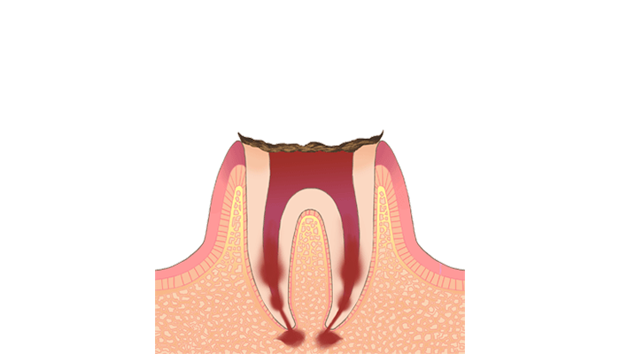 C4：歯質が失われた虫歯